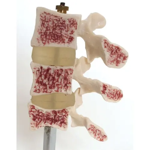 COL 1134 - Osteoporose - Image 3